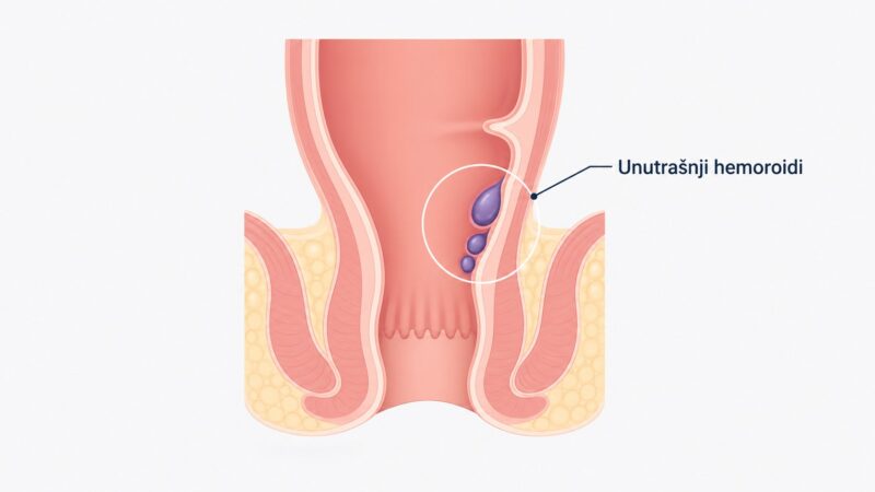 Medicinska ilustracija položaja unutrašnjih hemoroida u analnom kanalu